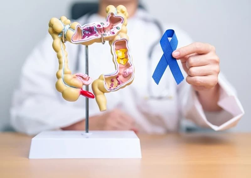 Effective Lifestyle Changes to Prevent and Avoid Colon Cancer